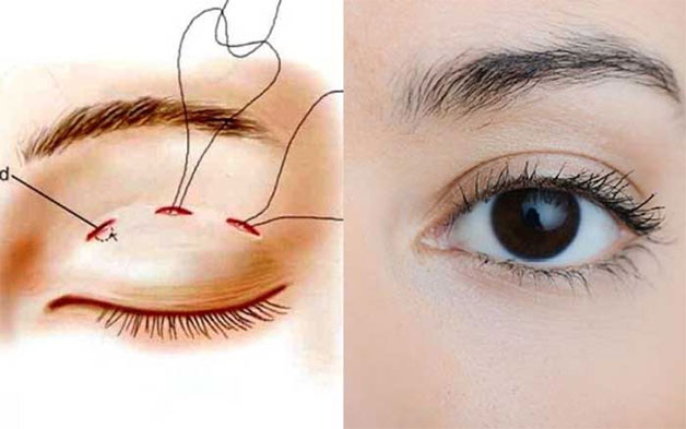 Nhấn mí mắt có thể duy trì được 3-5 năm hoặc dài hơn tùy theo từng trường hợp