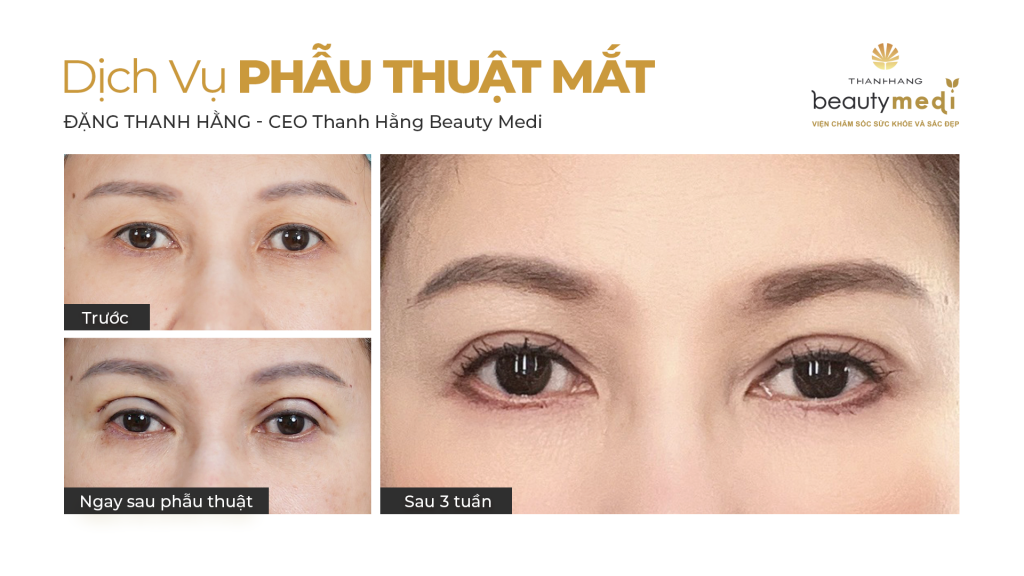 Hình ảnh khách hàng trước và sau khi thực hiện dịch vụ thẩm mỹ mí mắt tại Thanh Hằng Beauty Medi