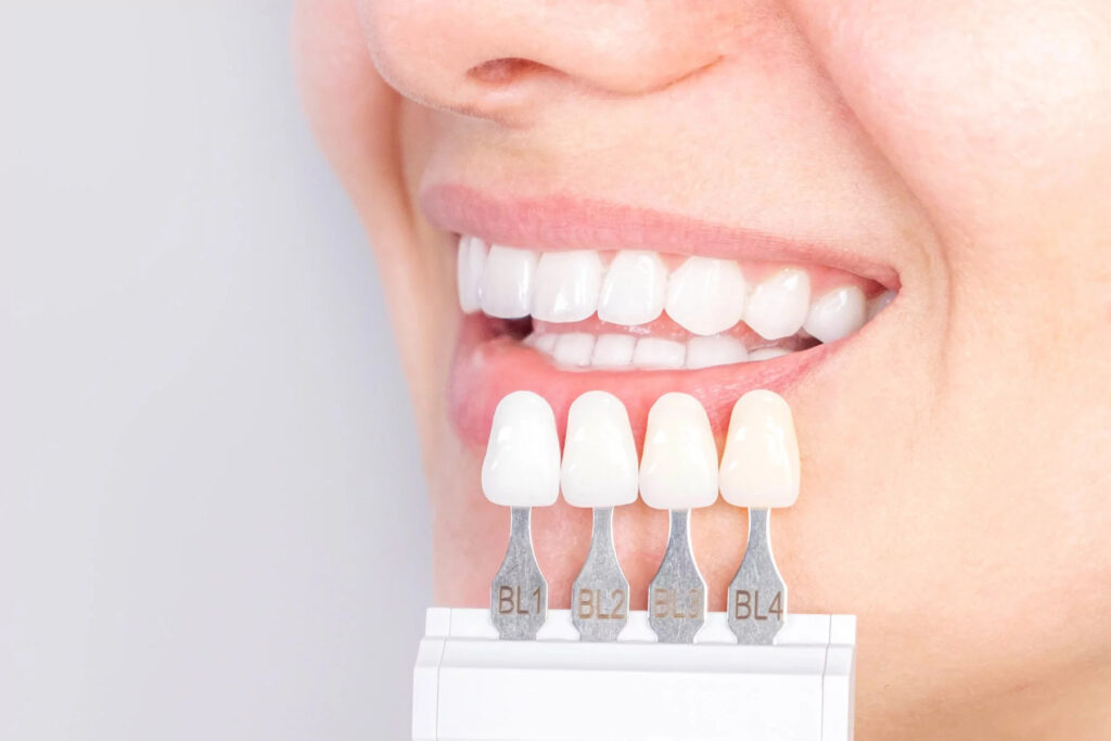 Bọc răng sứ giúp nâng cao tính thẩm mỹ của răng
