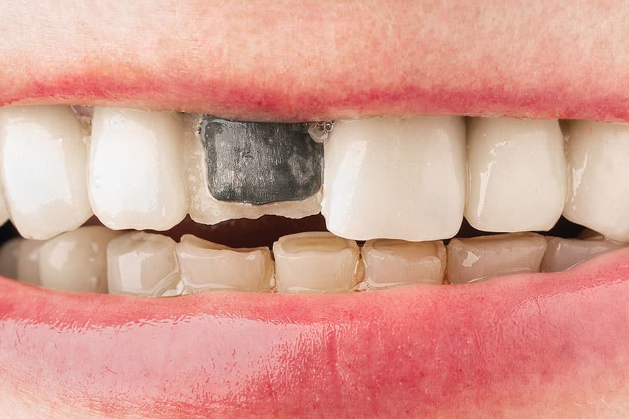 Răng sâu là một trong những trường hợp nên bọc răng sứ 