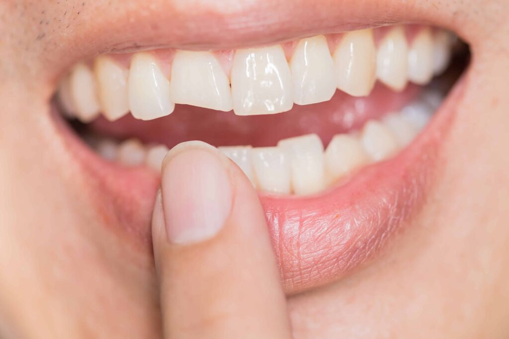 Răng không đều cũng có thể bọc răng sứ