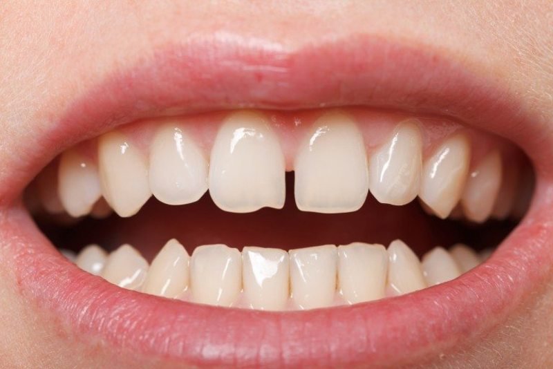 Bọc răng sứ là giải pháp phù hợp để khắc phục răng thưa, có kẽ hở