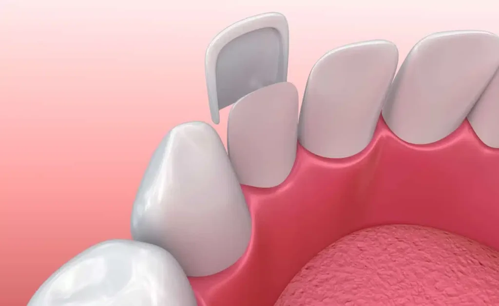 Răng đã trám vẫn có thể bọc sứ 
