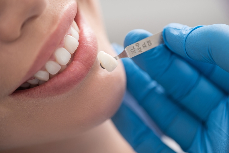 Răng sứ cao cấp là một loại răng giả được làm hoàn toàn từ vật liệu sứ nguyên khối