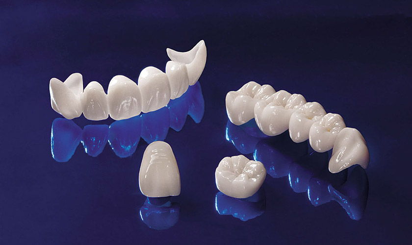 Răng sứ cao cấp E.Max được cấu tạo từ những sợi gốm sứ thủy tinh công nghệ cao