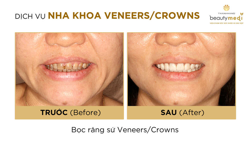 Hình ảnh trước và sau khi khách hàng sử dụng dịch vụ bọc răng sứ Crown tại Thanh Hằng Beauty Medi