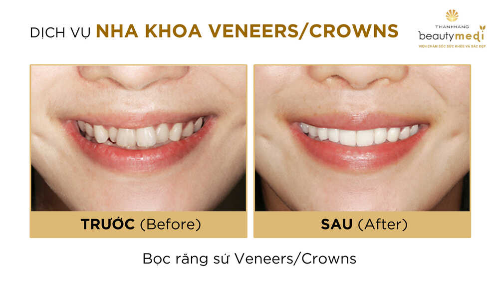 Hình ảnh trước và sau khi khách hàng sử dụng dịch vụ bọc răng sứ Crown tại Thanh Hằng Beauty Medi