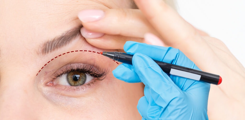 Mí mắt không hài hòa với gương mặt thì bạn có thể tham khảo biện pháp sửa mí hỏng