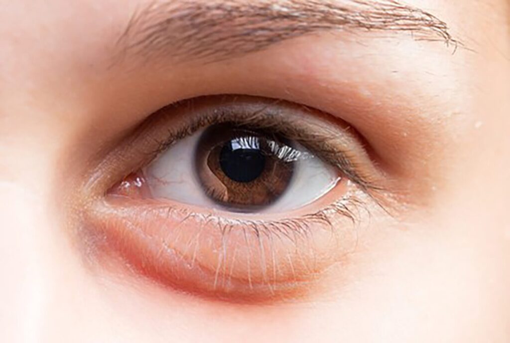Mí mắt bị sưng, viêm là dấu hiện của việc sửa mí bị hỏng