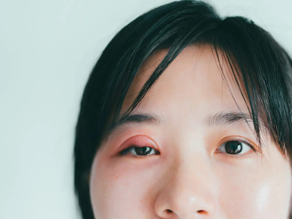 Khi mắt bị sưng đỏ sau cắt mí thì bác sĩ sẽ chỉ định sử dụng thuốc chống viêm
