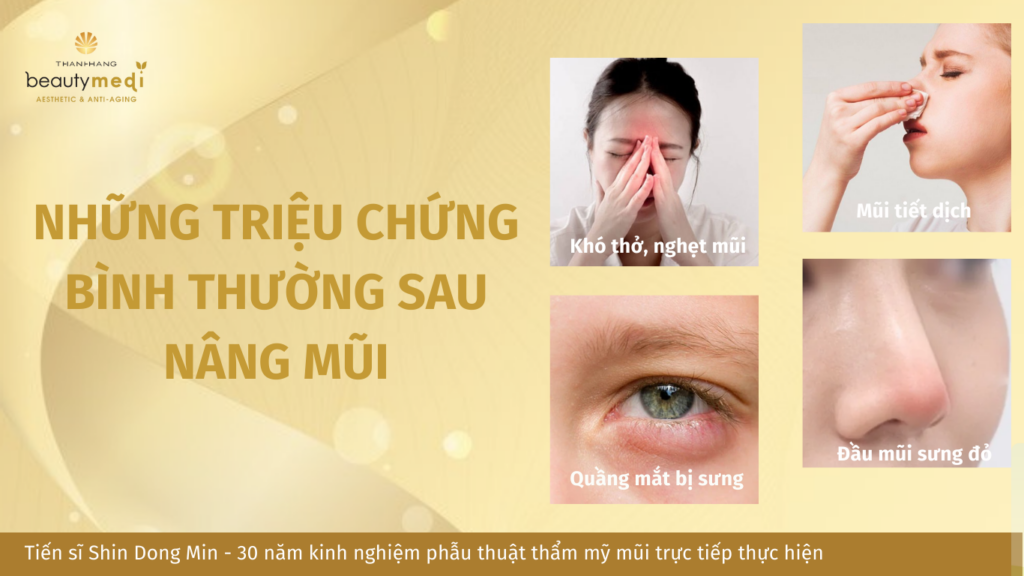 Những triệu chứng sau nâng mũi
