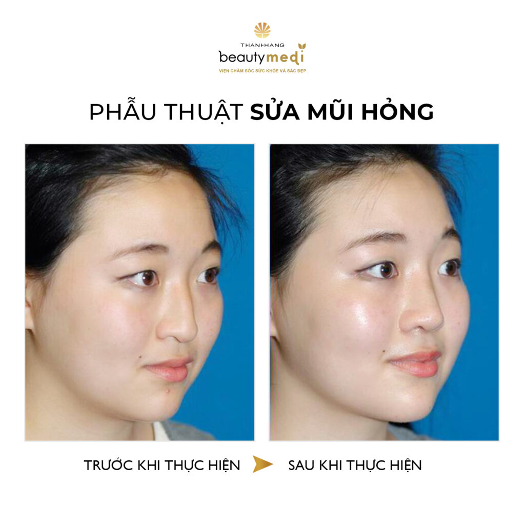 Hình ảnh trước và sau khi phẫu thuật của khách hàng tại Thanh Hằng Beauty Medi 