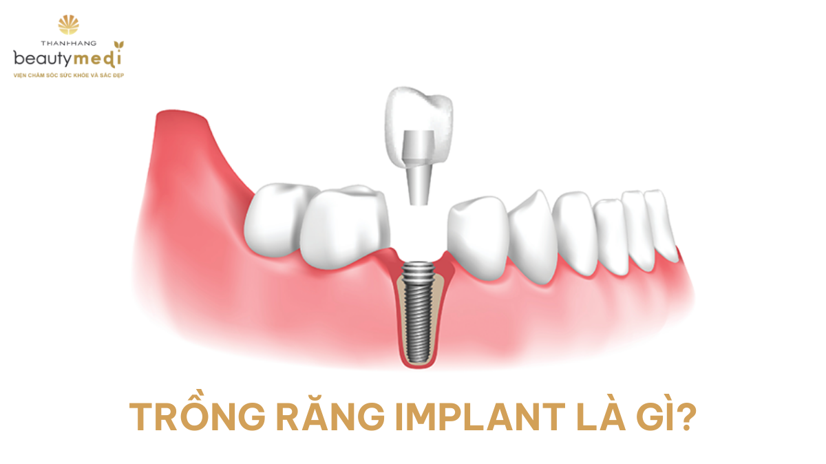 trồng răng Implant là gì?