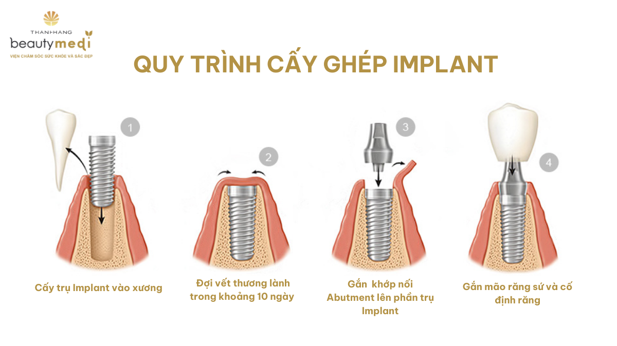 Chu trình cấy ghép Implant