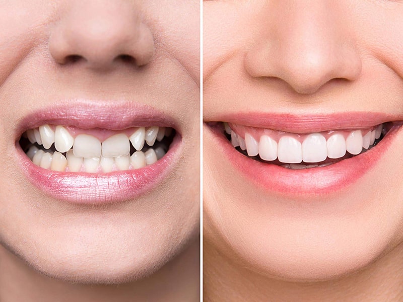Bọc răng sứ không duy trì vĩnh viễn được