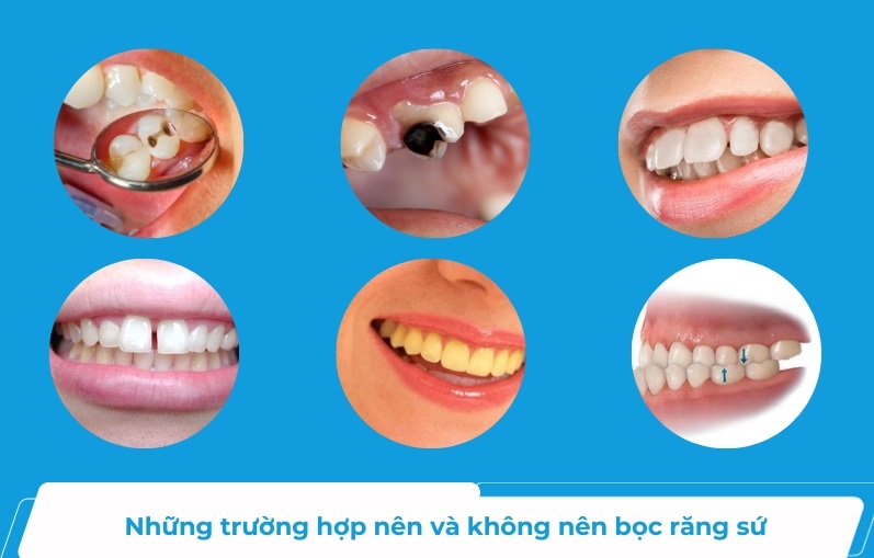 Không phải ai cũng có thể bọc răng sứ 