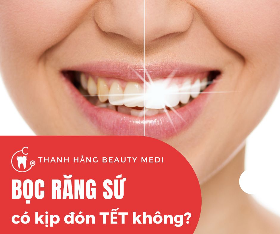 Bọc răng sứ ở thời điểm hiện tại vẫn kịp ăn Tết