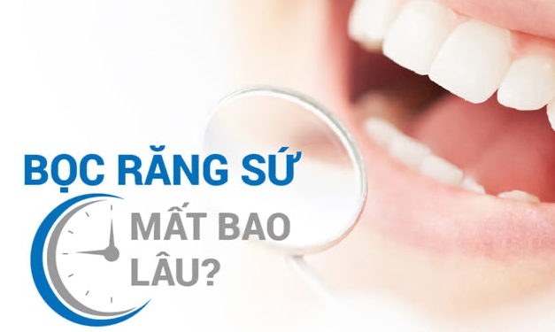 Thời gian bọc răng sứ hoàn thiện từ vài ngày đến vài tuần
