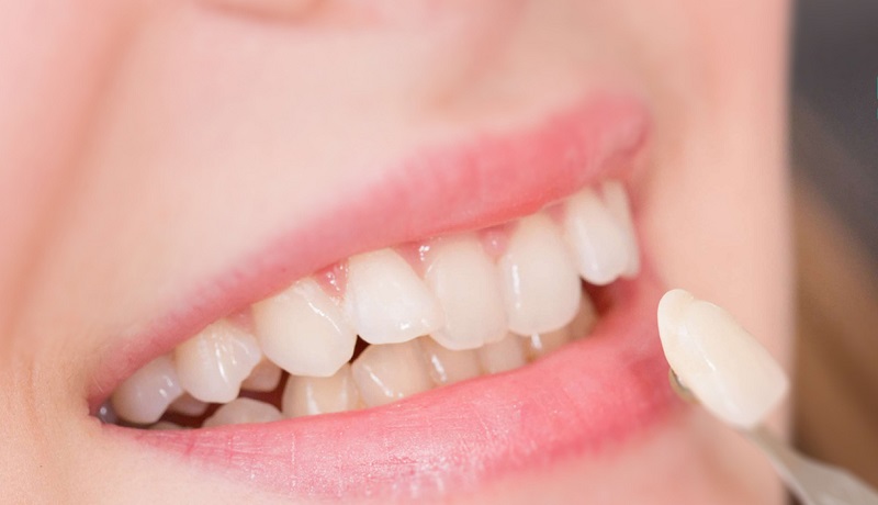 Bọc răng sứ trước Tết để có nụ cười xinh đầu xuân, cả năm may mắn