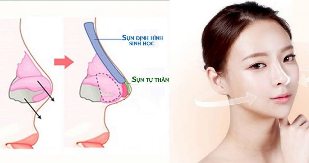 Chăm sóc mũi sau phẫu thuật theo đúng hướng dẫn để ngăn ngừa tình trạng sưng đỏ 