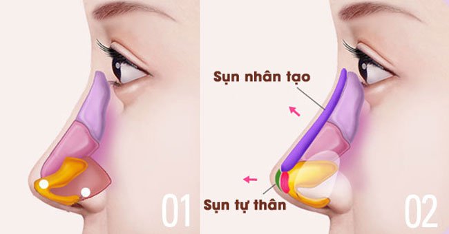 Tháo sụn là cách làm mũi hết đỏ, viêm nhiều 