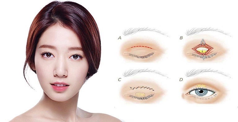 Thời điểm cắt mí mắt để kịp đón Tết là tháng 12 âm lịch