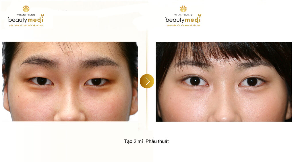 Hình ảnh trước và sau khi cắt mắt của khách hàng tại Thanh Hằng Beauty Medi