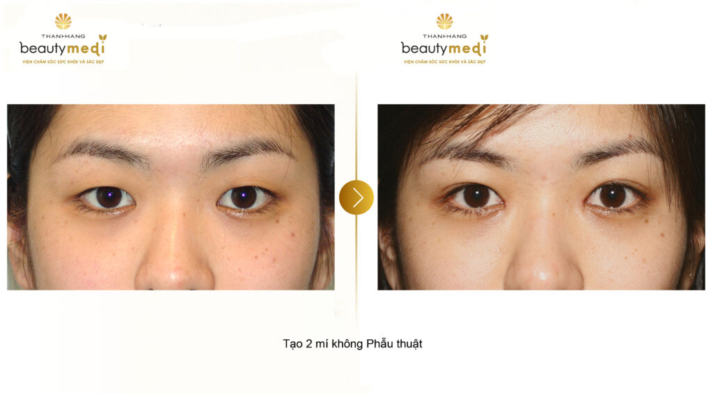 Hình ảnh trước và sau khi cắt mắt của khách hàng tại Thanh Hằng Beauty Medi