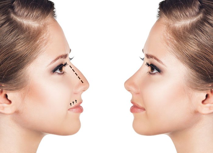 Thẩm mỹ mũi có thể sửa được những khuyết điểm gì trên khuôn mặt?