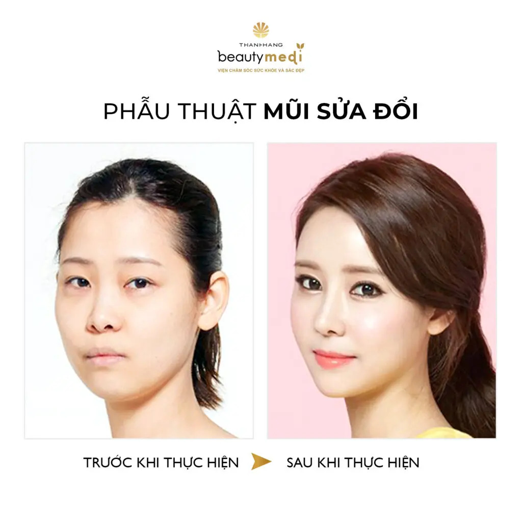 Hình ảnh thực tế của khách hàng khi nâng mũi tại Thanh Hằng Beauty Medi