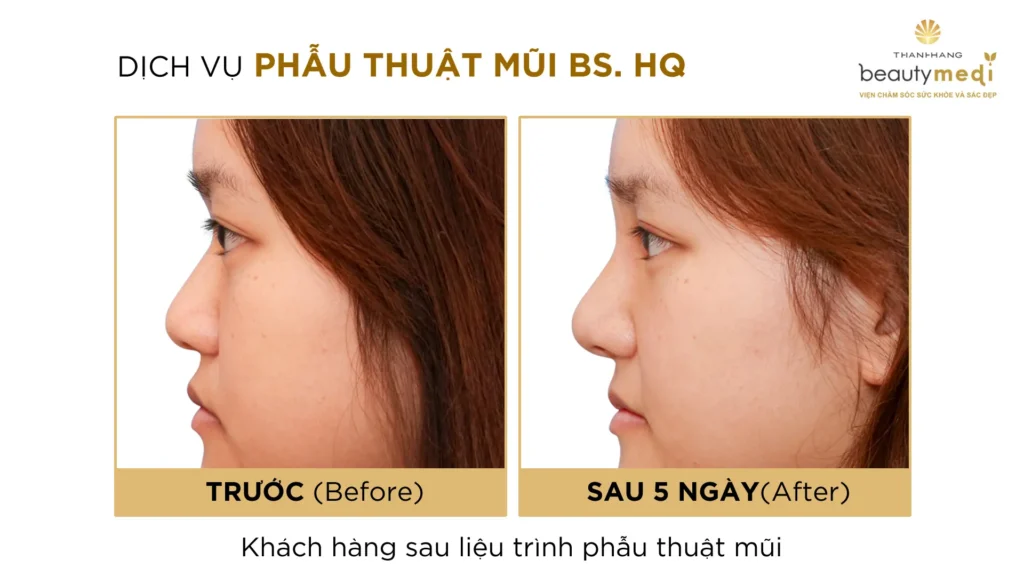 Hình ảnh khách hàng trước và sau khi nâng mũi và cắt mí tại Thanh Hằng Beauty Medi