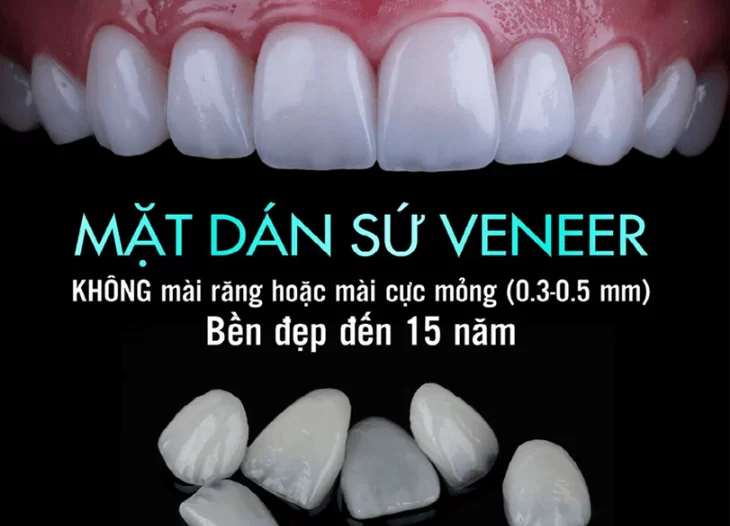 Dán răng sứ không mài có nhiều ưu điểm nổi bật