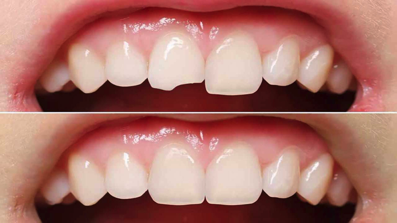 Răng sứt mẻ nhẹ nên áp dụng phương pháp dán sứ không mài