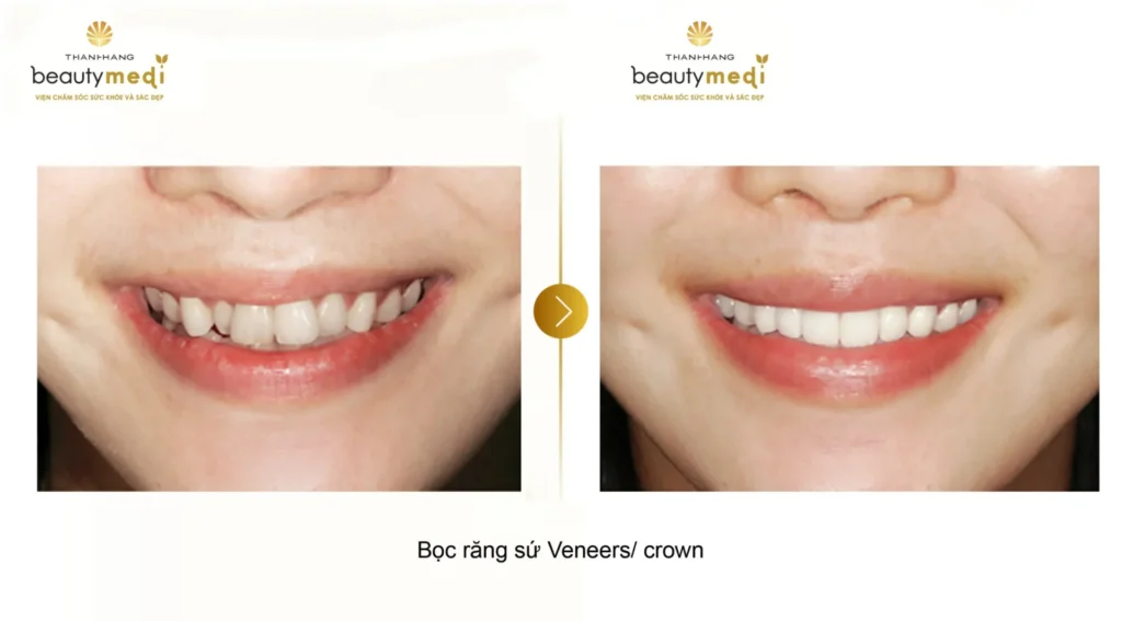 Quy trình dán răng sứ Veneer tại Thanh Hằng Beauty Medi
