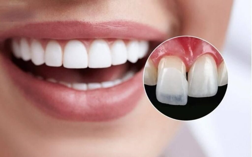Hoàn toàn có thể dán sứ Veneer 2 răng cửa thưa