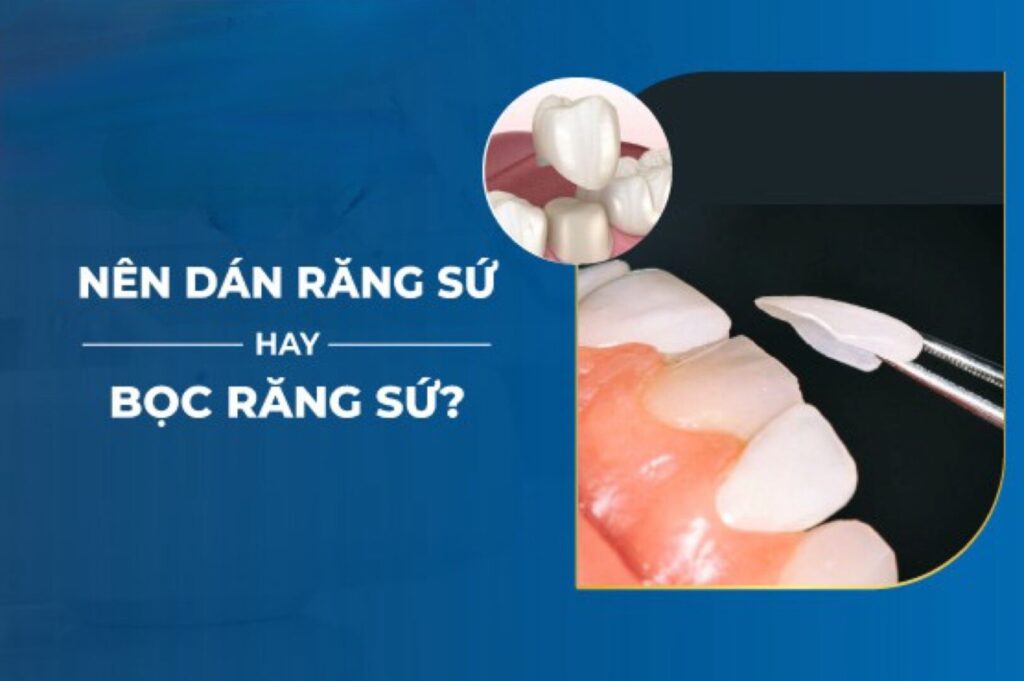 Tùy từng trường hợp bác sĩ sẽ tư vấn nên dán sứ dán sứ Veneer hay bọc sứ