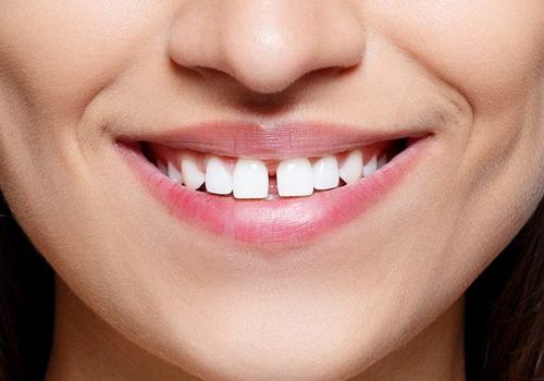 Răng cửa bị thưa nên dán sứ Veneer để cải thiện