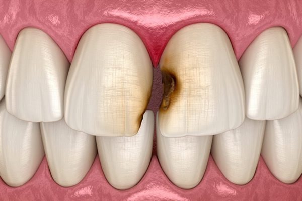 Dán sứ Veneer có thể khắc phục tình trạng răng cửa bị sâu kẽ