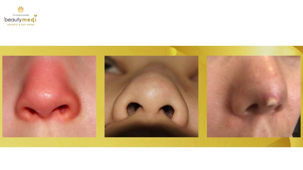 Nâng mũi sau 4-6 tuần thì sẽ hết to