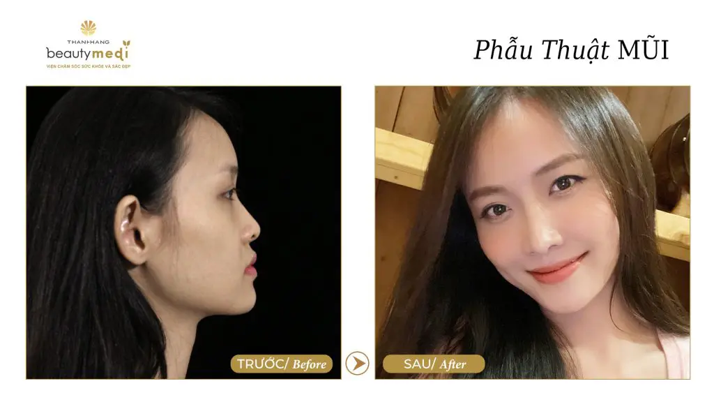 Hình ảnh thực tế của khách hàng phẫu thuật mũi thành công tại Thanh Hằng Beauty Medi