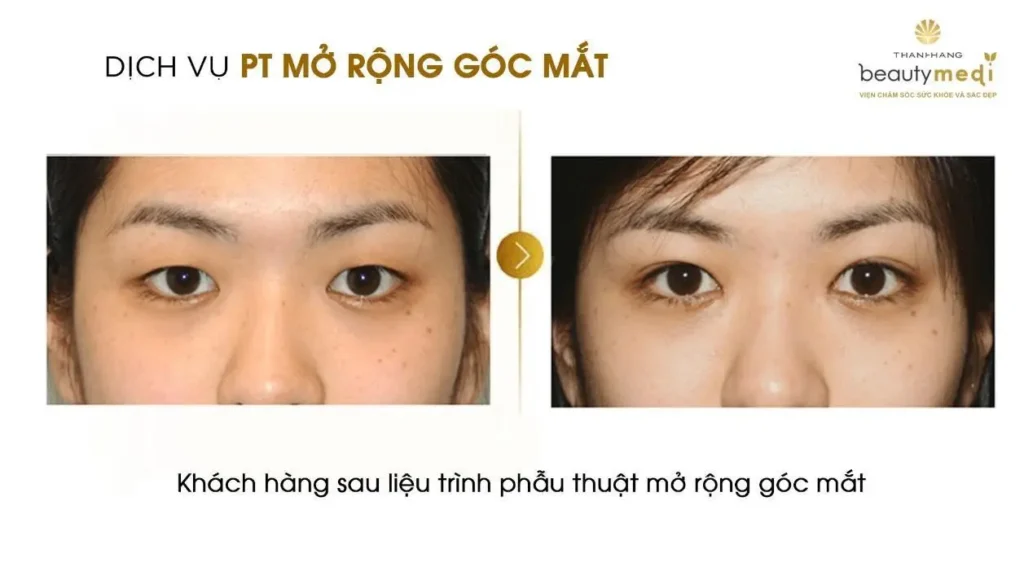 Hình ảnh trước và sau của khách hàng khi sử dụng dịch vụ mở rộng góc mắt tại Thanh Hằng Beauty Medi