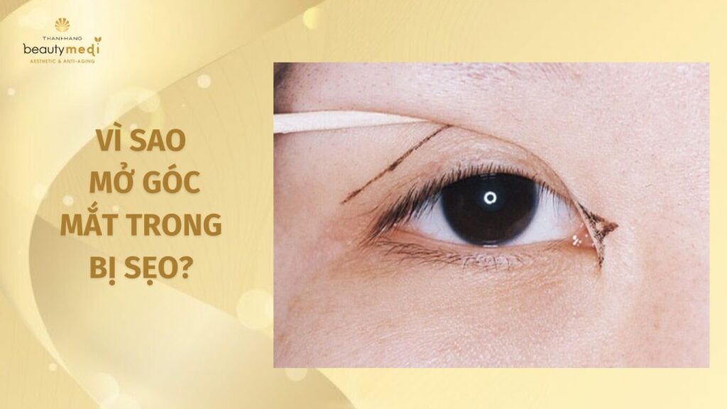 Nguyên nhân tại sao mở góc mắt trong lại bị sẹo