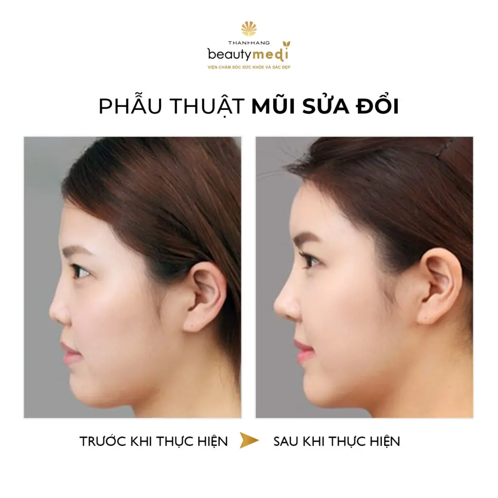 Hình ảnh thực tế của khách hàng trước và sau khi nâng mũi tại Thanh Hằng Beauty Medi