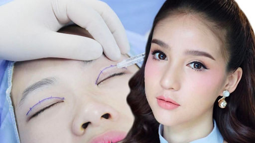 Phương pháp nhấn mí bằng chỉ phù hợp nhất với những người trẻ Phương pháp nhấn mí bằng chỉ phù hợp nhất với những người trẻ