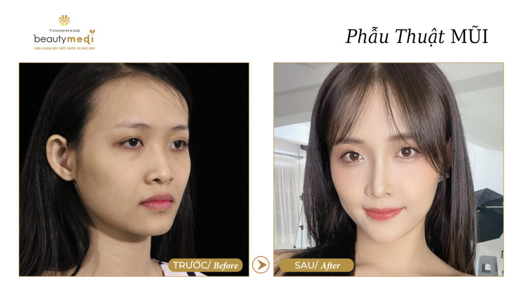 Hình ảnh trước và sau của khách hàng khi phẫu thuật mũi tại Thanh Hằng Beauty Medi
