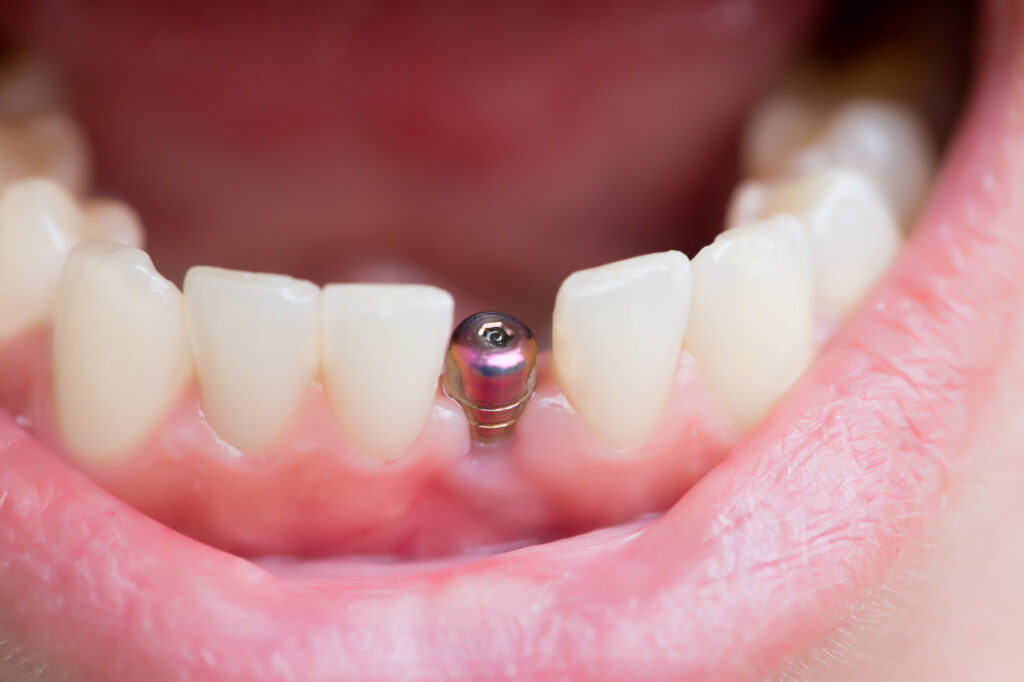 Trụ răng Implant Hàn Quốc sở hữu nhiều ưu điểm nổi trội 