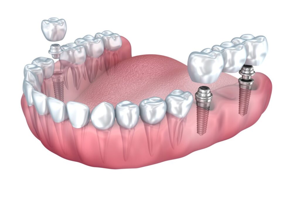 Tìm hiểu trồng răng Implant Hàn Quốc có tốt không