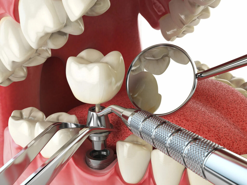 Trồng răng Implant là kỹ thuật đang được ưa chuộng
