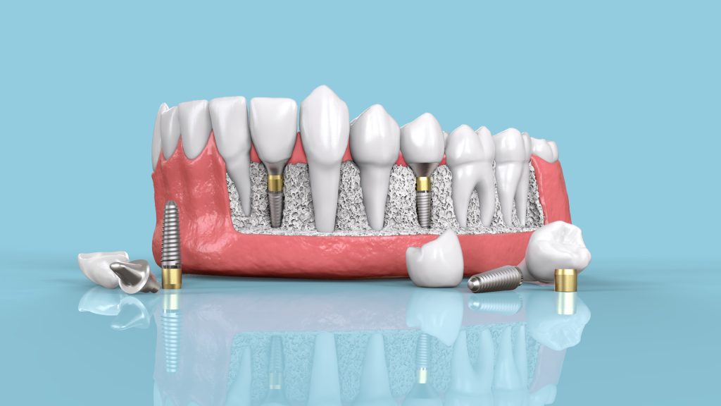 Trồng răng Implant Hàn Quốc có nhiều loại để lựa chọn